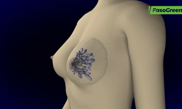 fr2 Cancer du sein : Tout savoir avec le Docteur YAMÉOGO